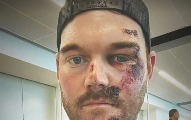 Grayson Murray Gets 50 Stitches Soon after Grotesque Scooter Incident – uBetMobile.com