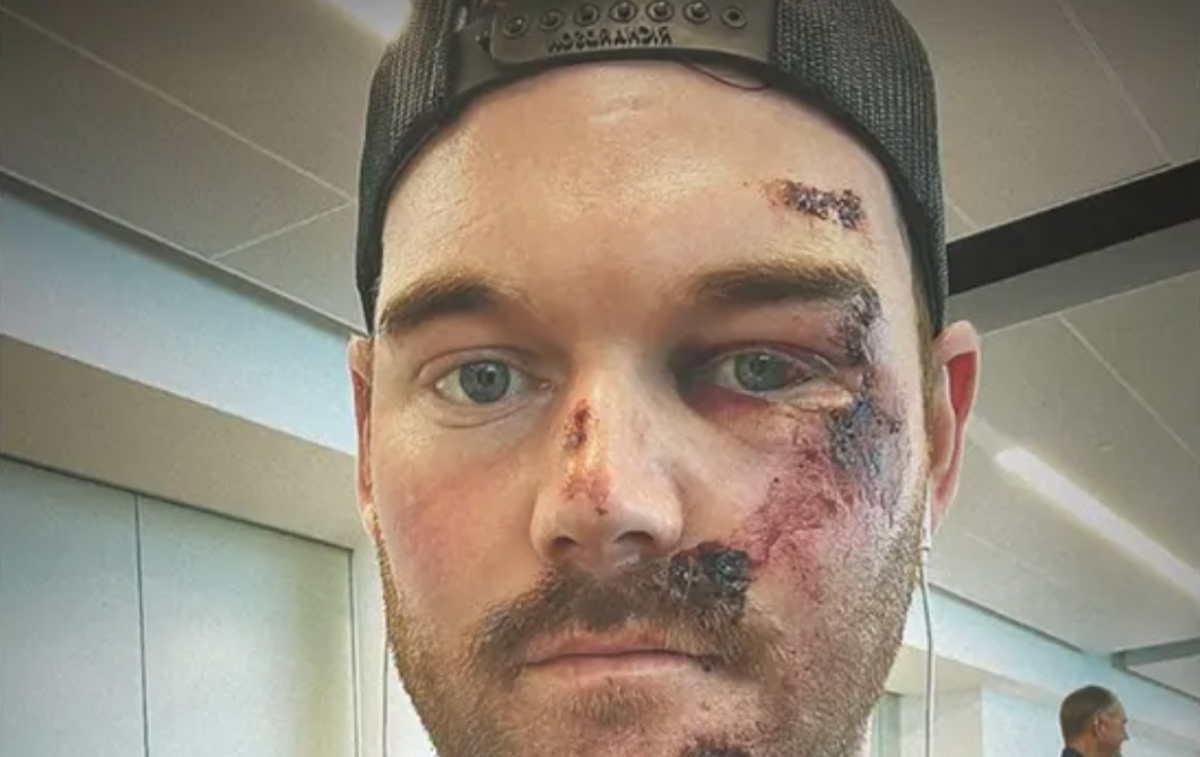 , Grayson Murray Gets 50 Stitches Soon after Grotesque Scooter Incident &#8211; uBetMobile.com