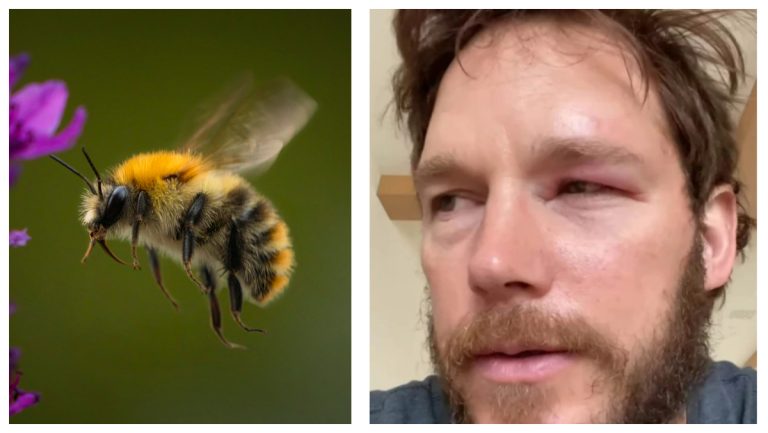 Chris Pratt Acquired Stung In The Eye By A Bee And It Seems Horribly Painful – uBetMobile.com