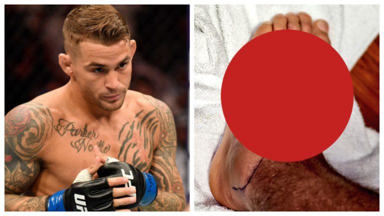 Dustin Poirier Shares Graphic Glimpse At Staph An infection – Mobile Betting On the internet – uBetMobile.com