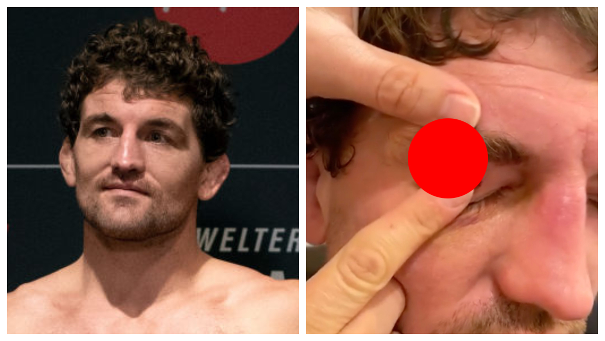 , Ben Askren Splits His Eyelid Open up: Video – Mobile Betting On the web &#8211; uBetMobile.com